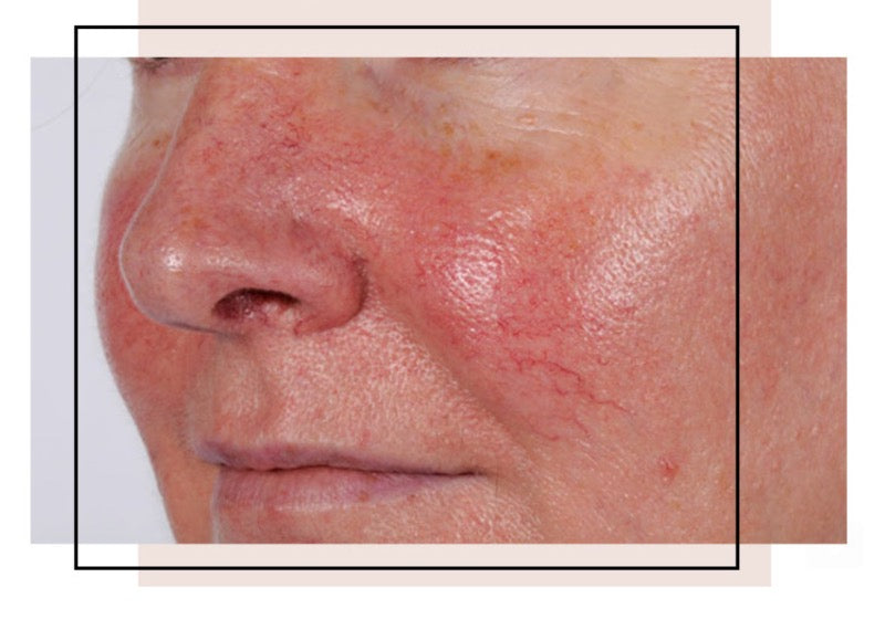 Are You a Little Rosy? – Raw Canvas Skin Clinic