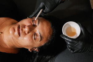 Chemical Peels