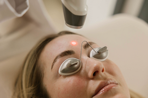 Tier 3 - Laser Genesis + Chemical Peel